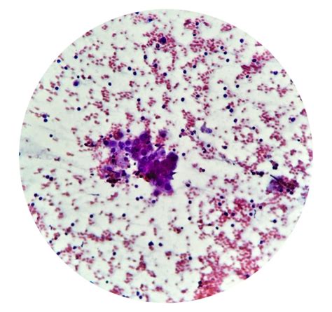 Estudio citológico de masa intraabdominal sarcoma de células fusiformes