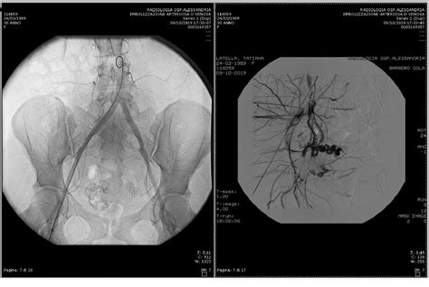 Figure 2 From Uterine Arteriovenous Malformation After First Trimester