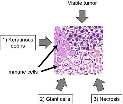 Frontiers Immunotherapy For Head And Neck Cancer A Paradigm Shift