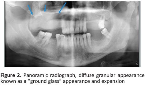 Fibrous Dysplasia Ground Glass