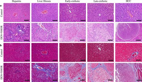 Histological Observations Of Liver Samples At Different Pathological