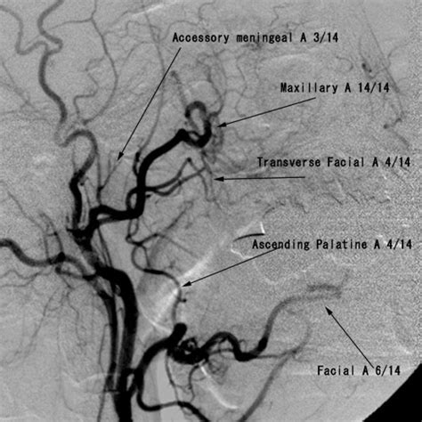 External Carotid Artery