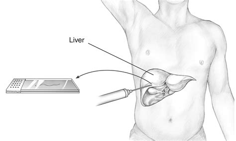 Liver Biopsy Procedure Media Asset Niddk