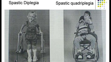 Cerebral Palsy (CP) | Spastic Diplegia Paraplegia Hemiplegia Sequelae ...