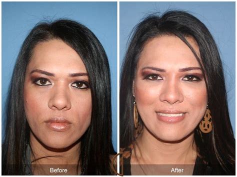 Facial Fat Grafting Before & After Photos From Dr. Kevin Sadati