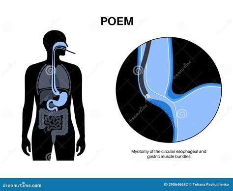 POEM medical poster stock vector. Illustration of esophageal - 290646682