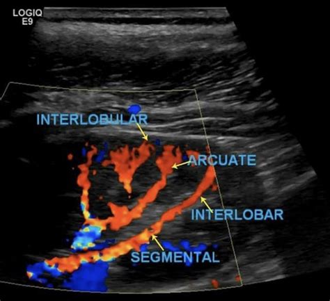 Renal Transplant Duplex Protocol – Sonographic Tendencies