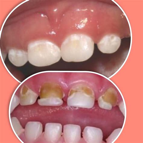 Does Your Child Suffer From Early Childhood Caries Dr Shweta Bhatia