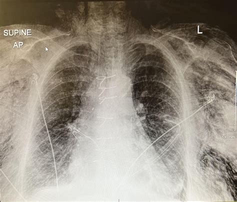 Subcutaneous Emphysema Rradiology