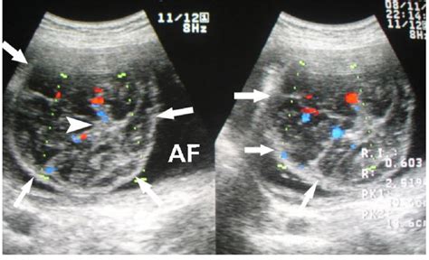 Fetal Acrania. Color Doppler ultrasound scan of the fetal brain in ...