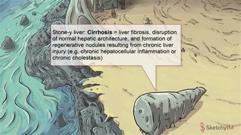 Cirrhosis SOA Free Sketchy Medical Lesson