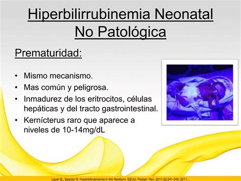 Ictericia Del Recien Nacido Ppt