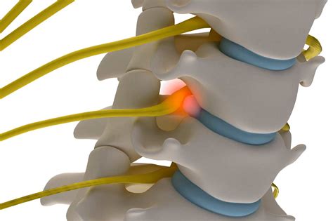 Protrusione Discale E Discopatia Il Chiropratico