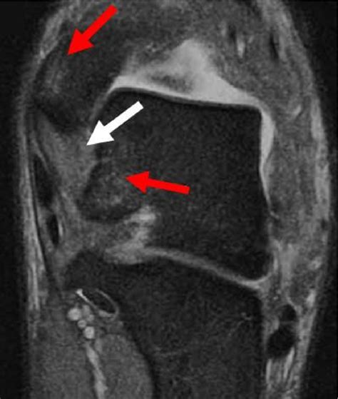 Figure 2 From Mri Imaging Of Impingement Syndromes Of The Ankle