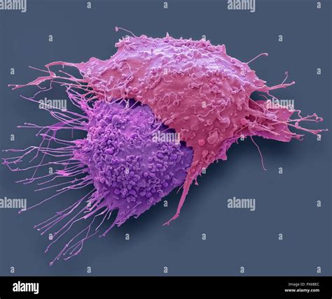 Ovarian Cancer Cells Coloured Scanning Electron Micrograph Sem Of Ovarian Cancer Cells