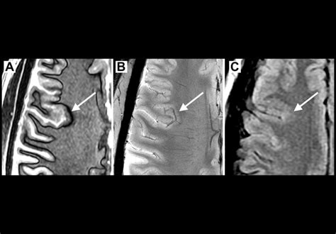 7 T Mri Identifying Lesions For Optimal Epilepsy Care Mayo Clinic