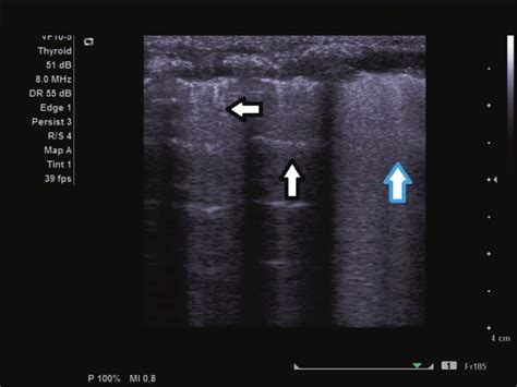 A Normal Lung Ultrasound Pattern Horizontal A Lines Arrow