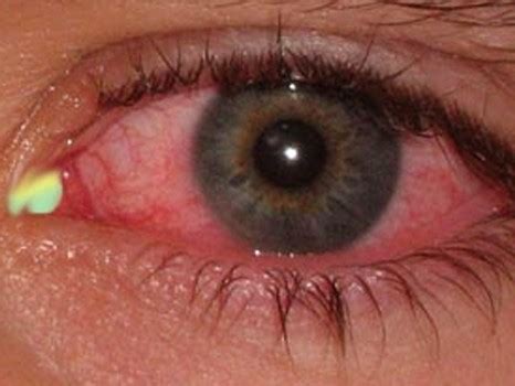 👉 Mucus in Eye - Types, Pictures, Home Remedies, Yellow Mucus (November ...