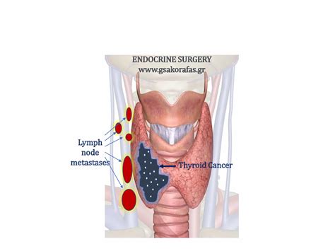 Thyroid Cancer Lymph Node Metastasis Prognostic Significance