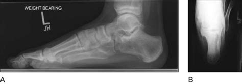 46 Resection Of Talocalcaneal Tarsal Coalition And Fat Autograft