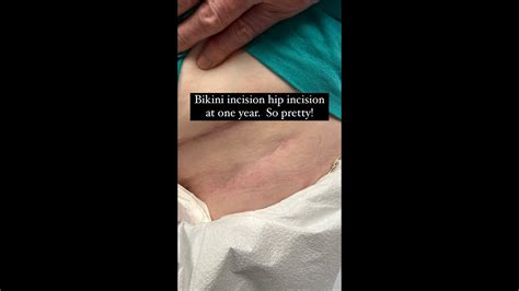 1 Year Follow Up Doing Great Left Bikini Incision Anterior Hip