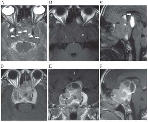 Figure 1 From Fluid Fluid Level On Magnetic Resonance Images May