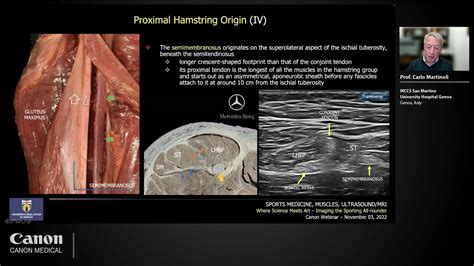 Hamstring Tear Ultrasound