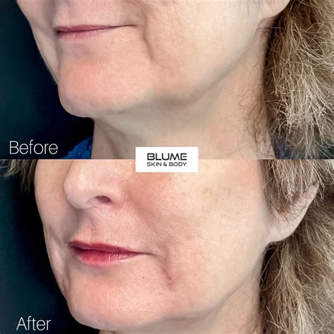 Dermal Fillers Before And After Photos Scottsdale Arizona