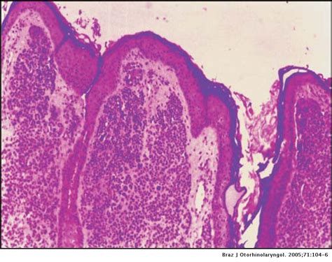 Junctional Nevus Histology