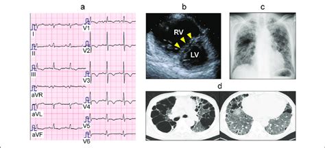 Initial Cardiac Findings A Electrocardiogram Sinus Rhythm Heart