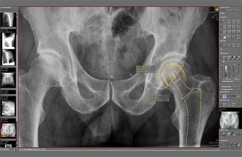 Medical Imaging Software Module Dicompacs Prosthesis Or Technology