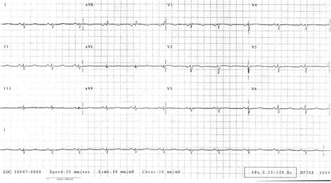 Typical Appearance Of The Ecg In Al Amyloidosis Of The Heart There Is