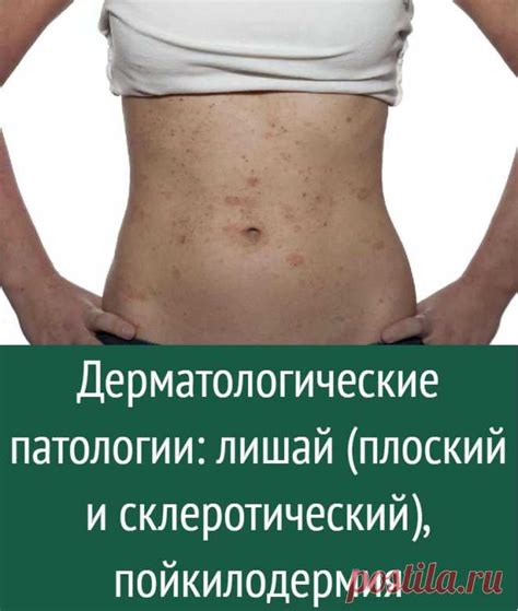 Дерматологические патологии: лишай (плоский и склеротический), пойкил ...