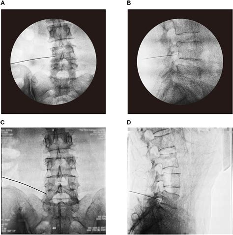 Frontiers Clinical Outcome Of Pulsed Radiofrequency Combined With