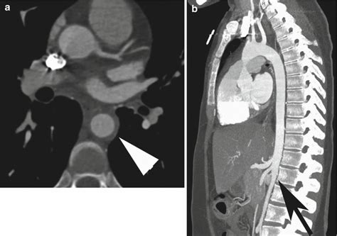 Aortic Aneurysms Fistula And Thrombus Radiology Key