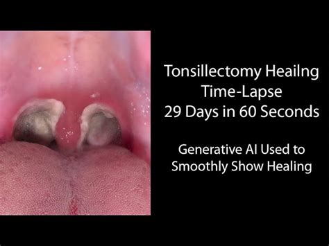 Before And After Tonsillectomy