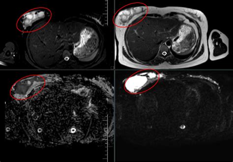 Mri Of Chest Wall Demonstrating Right Breast Abscess Indicated By Red