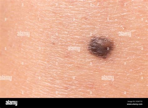 Mole Birthmark Nevus Macro Photo On Human Skin Close Up Stock Photo