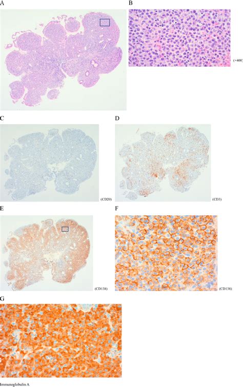 Figure3 Histopathological Characteristics Of Immunoproliferative Small