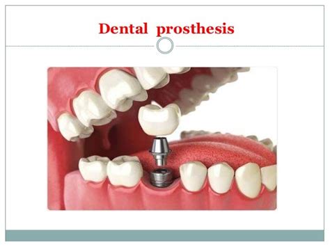 Prosthetic Body Parts