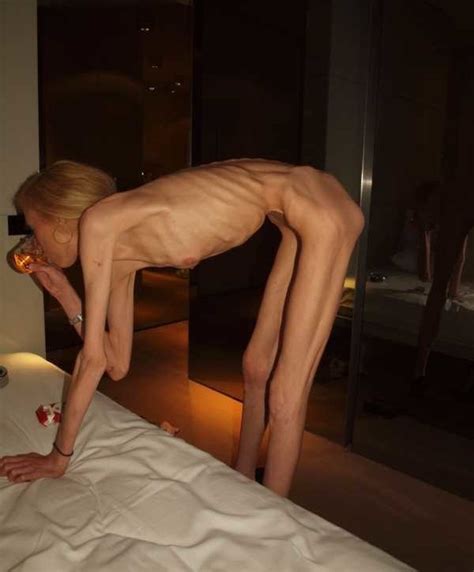 Prostitute Anorexia Asia Photos Porn