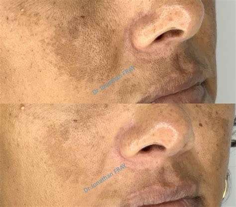 Peeling La R Union Peelings Du Visage Et De La Peau Docteur Fray