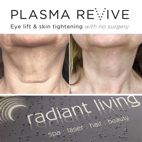 Plasma Revive Eye Lift Skin Tightening Without Surgery