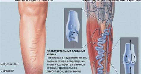 ФЛЕБОЛОГИЯ ДЛЯ "ЧАЙНИКОВ": ЧТО ПРОИСХОДИТ С ВЕНАМИ ПРИ ОТЕКАХ?