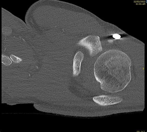 Figure From Subcoracoid Acromioclavicular Joint Dislocation Rockwood