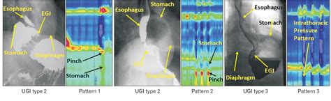 Figure 1 from Morphology of the Esophageal Hiatus: Is It Different in 3 ...