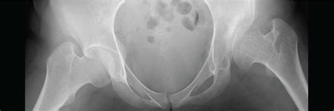 A 20-year-old woman with severe acetabular dysplasia. (a) Preoperative ...