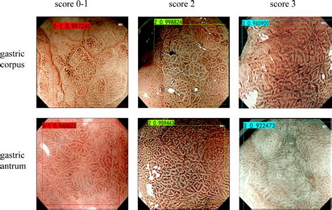 A Deep Learning Model Based On Magnifying Endoscopy With Narrow Band Imaging To Evaluate