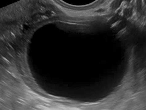 Simple ovarian cyst. Ultrasound image of the ovary shows a simple cyst ...