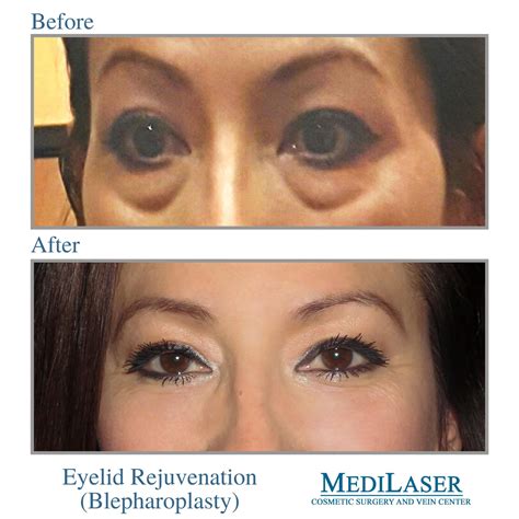 Blepharoplasty Before And After Medilaser Surgery And Vein Center